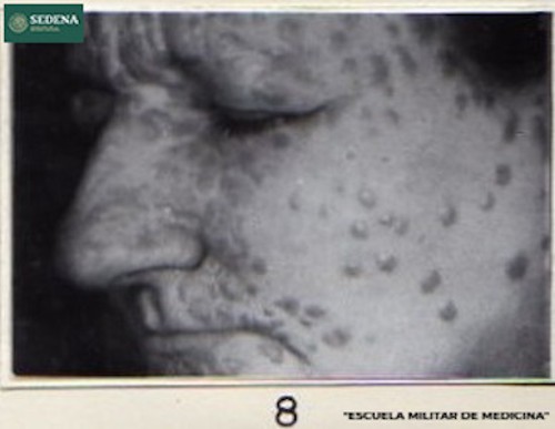 Imagen de Lesiones de etapa 2 de sífilis en el rostro (atribuido)