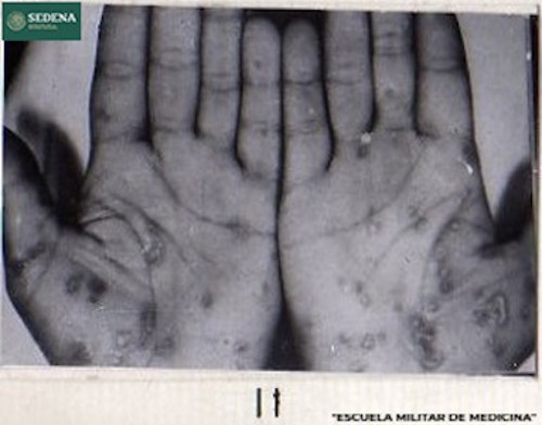 Imagen de Lesiones de etapa 1 de sífilis en las manos (atribuido)