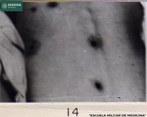 Imagen de Lesiones de etapa 1 de sífilis en la espalda (atribuido)