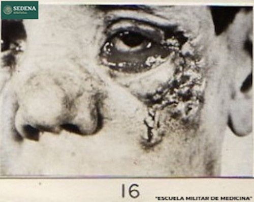 Imagen de Rostro de un paciente en etapa 3 de sífilis (atribuido)