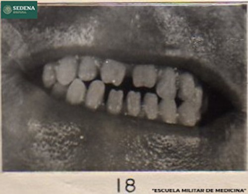 Imagen de Boca de un paciente entrando a etapa 2 de sífilis (atribuido)