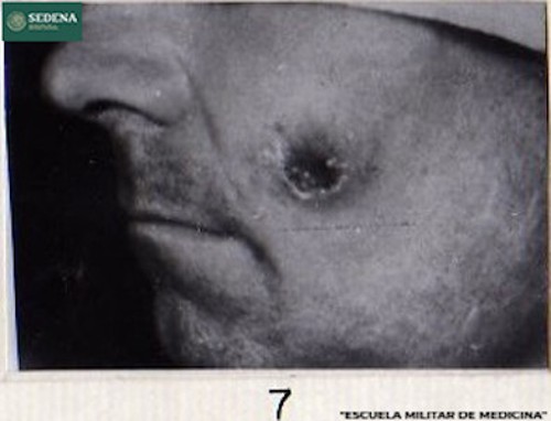 Imagen de Lesión de etapa 1 de sífilis en el pómulo (atribuido)