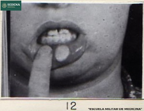 Imagen de Lesión de etapa 1 de sífilis en la boca (atribuido)