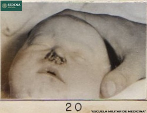 Imagen de Recién nacido con lesiones de etapa 3 de sífilis en la nariz (atribuido)